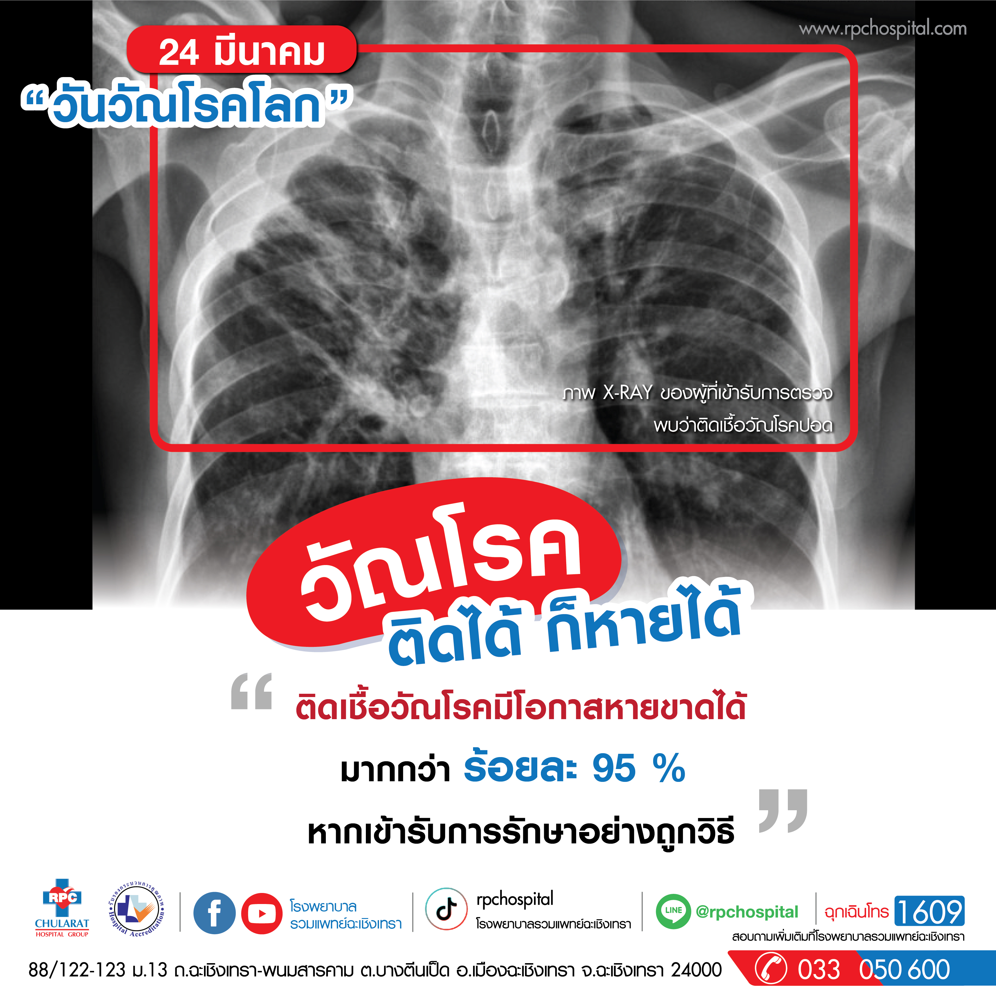 วัณโรค (Tuberculosis:TB) - ความรู้สุขภาพ - โรงพยาบาลรวมแพทย์ฉะเชิงเทรา