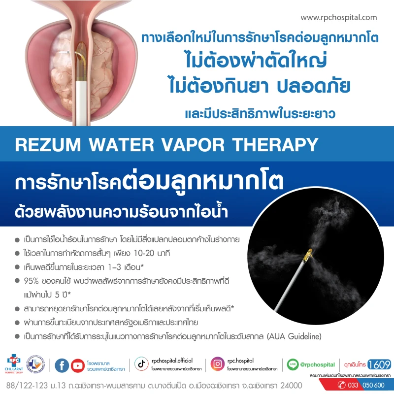การรักษาโรคต่อมลูกหมากโต ด้วยพลังงานความร้อนจากไอน้ำ